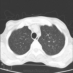 Radiografie și cancer pulmonar