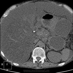 Radiografie și cancer pulmonar