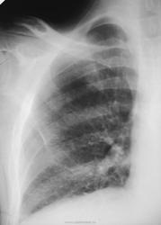 Radiografie și cancer pulmonar