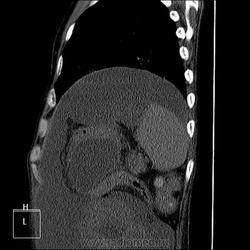 Radiografie și cancer pulmonar