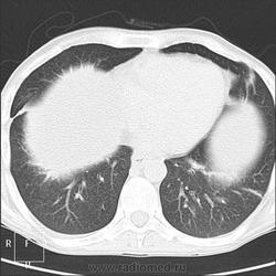 Radiografie și cancer pulmonar