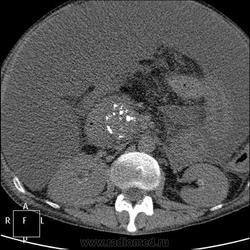 Radiografie și cancer pulmonar