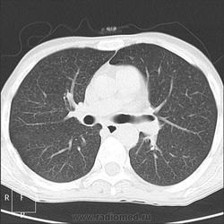 Radiografie și cancer pulmonar