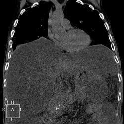 Radiografie și cancer pulmonar