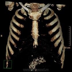 Radiografie și cancer pulmonar