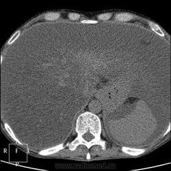 Radiografie și cancer pulmonar