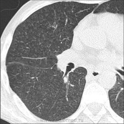 Radiografie și cancer pulmonar