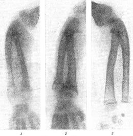 Imagine radiografică a scheletului în rahitism