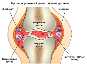 Reacții de artrită reumatoidă, semne radiologice