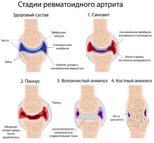 Reacții de artrită reumatoidă, semne radiologice