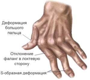Reacții de artrită reumatoidă, semne radiologice