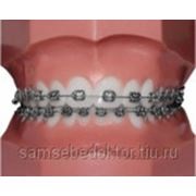 Sapphire braces perfect (set) în Ryazan (materiale dentare) - păstrați-vă medicul