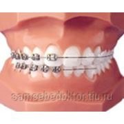 Sapphire braces perfect (set) în Ryazan (materiale dentare) - păstrați-vă medicul