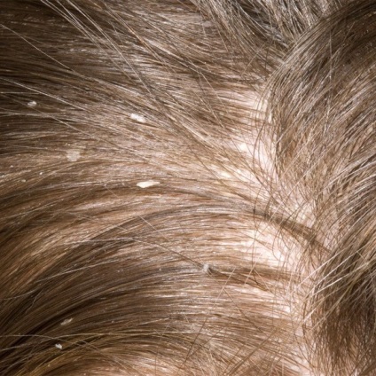 Seborrhea scalpului provoacă un tratament la domiciliu
