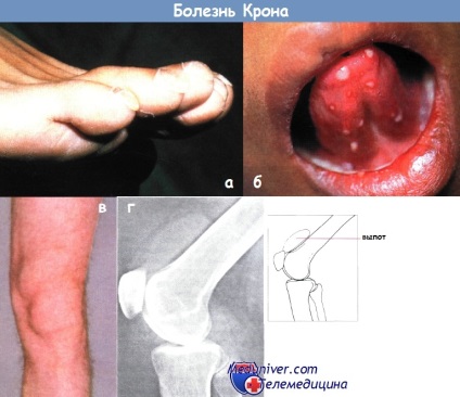 Tünetek A Crohn-betegség és a diagnózis