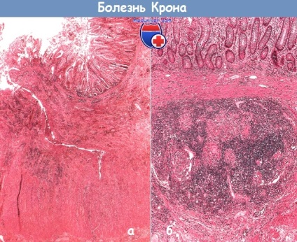 Simptomele bolii Crohn și diagnosticul acesteia