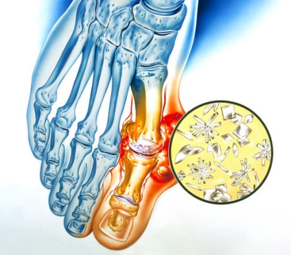 Simptomele și tratamentul artritei gute