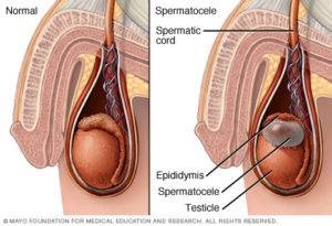 Simptomele și tratamentul spermatozoidelor la bărbați și copii provoacă, după operație