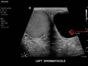 Simptomele și tratamentul spermatozoidelor la bărbați și copii provoacă, după operație