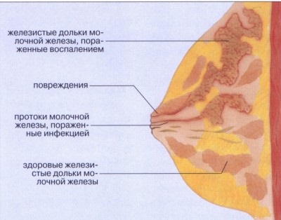 Simptomele și cauzele inflamației sânului (mastită)