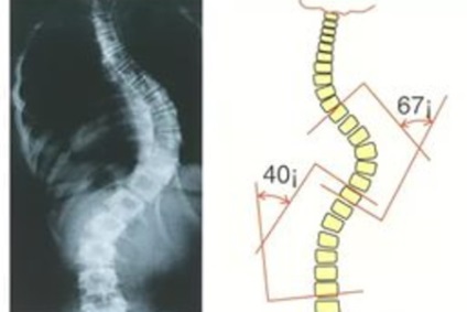 Scolioza coloanei vertebrale la adulți, tratament de 1, 2, 3 grade