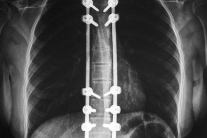 Scolioza coloanei vertebrale la adulți, tratament de 1, 2, 3 grade