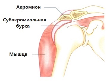 Szubakromiális bursitis a vállízület - kezelés, a tünetek (bursitis) Szubakromiális burzitiszével vállízület - kezelés, a tünetek