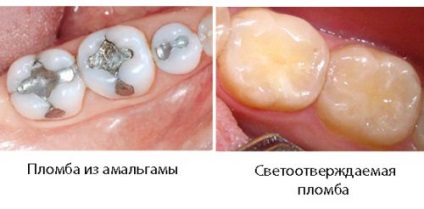Plăci dentare ușoare, materiale de etanșare ușoară