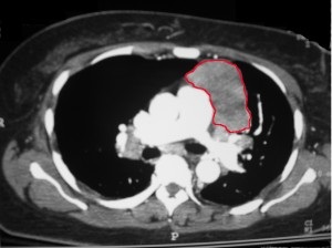 mediastinalis thymoma