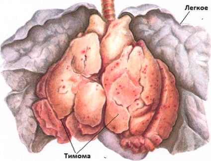 Mediastinalis thymoma csecsemőmirigy okait és a komplikációk kezelése a tumor felnőtteknél