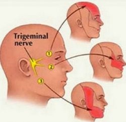 Nervus trigeminus tünetek és a kezelés a fájó