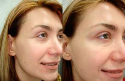 Recomandări privind injecțiile cu Botox, fotografie înainte și după, indicații