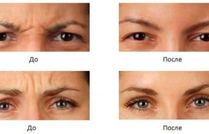 Recomandări privind injecțiile cu Botox, fotografie înainte și după, indicații