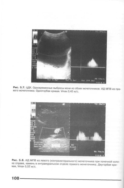 És Doppler ultrahang diagnosztizálására vesebetegségek