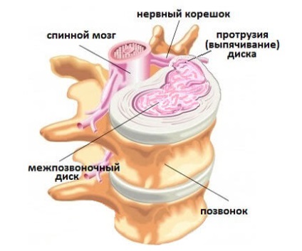 Exerciții cu proeminențe ale complexelor coloanei cervicale lfk