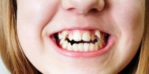 Copilul este în creștere un rând de dinți al doilea rând sau lapte de coacere ce să facă