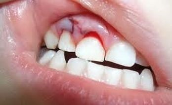 Leziuni ale clasificării dintelui la leziuni, simptome, prim ajutor, tratament