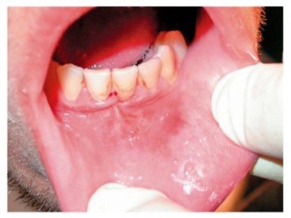 Leziuni ale clasificării dintelui la leziuni, simptome, prim ajutor, tratament