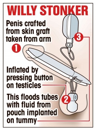 Videoclipul omului a fost implantat cu primul penis bionic din lume