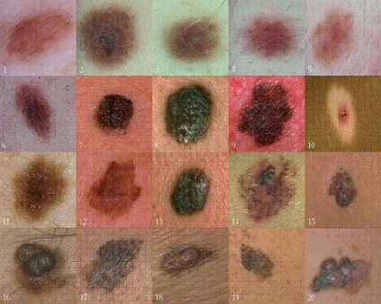 Tipuri de exemple de fotografie melanom, tratament, cum arată diferite tipuri