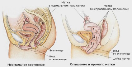 Prolaps uterin la femeile fotografice, cauze, simptome și tratament