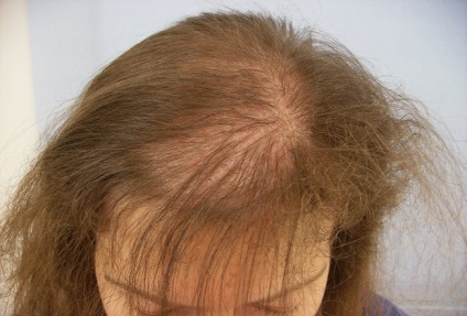 Căderea părului după terapia cu medicamente antivirale, probleme cu părul