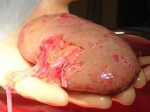 Rinichi artificial implantat