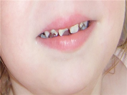 Dislocarea dintelui la un copil - simptome și tratament
