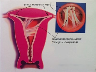 Sinechiile intrauterine