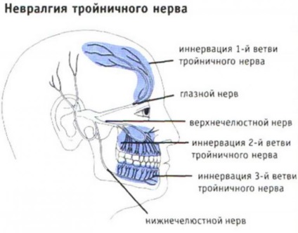 Inflamația nervului trigeminal - tratamentul nervului trigeminal