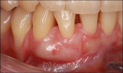 Reconstrucția septului osos interdental cu eliminarea recesiunii gingiei