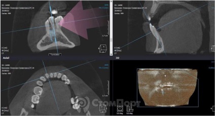 Reconstrucția septului osos interdental cu eliminarea recesiunii gingiei