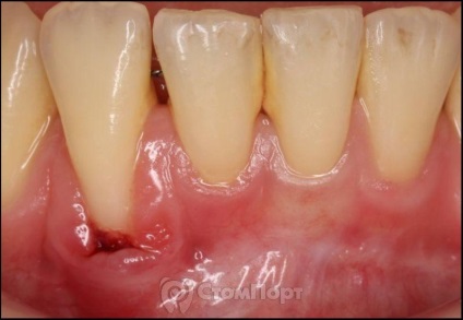 Reconstrucția septului osos interdental cu eliminarea recesiunii gingiei