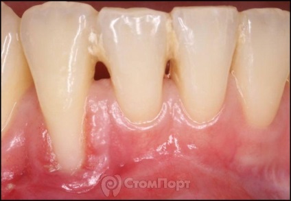 Reconstrucția septului osos interdental cu eliminarea recesiunii gingiei